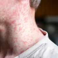 همه چیز درباره سرخک؛ از عوامل شیوع تا راه‌های پیشگیری