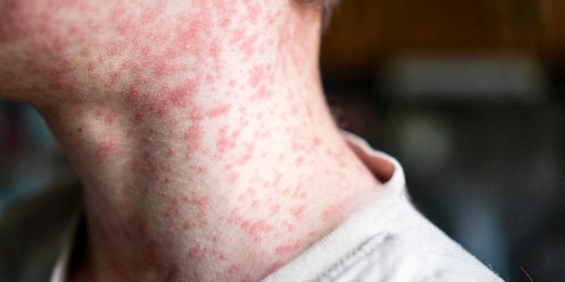همه چیز درباره سرخک؛ از عوامل شیوع تا راههای پیشگیری